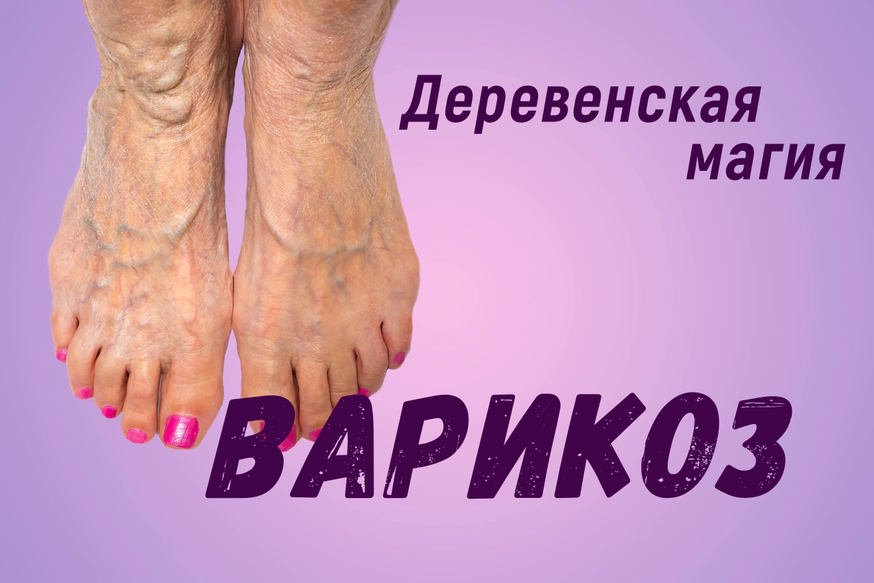 Варикозное расширение вен. смотреть онлайн