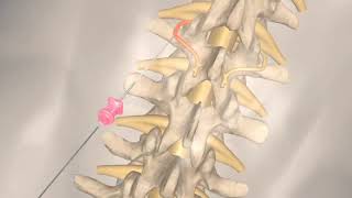 РЧА - лечение боли в спине. смотреть онлайн