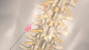 РЧА - лечение боли в спине.