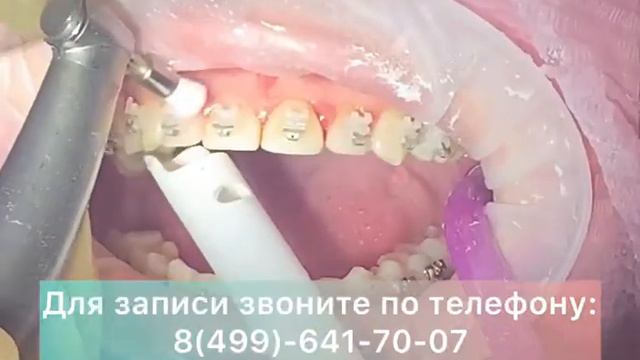 Гигиена полости рта с брекетами. Витаника Химки смотреть онлайн