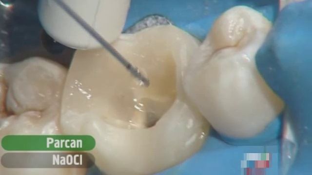 Ирригация корневых каналов смотреть онлайн