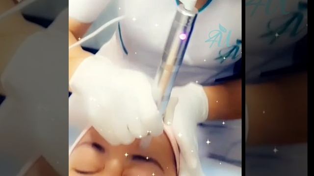 Beauty Center For You , MICRONEEDLING - Avant et après - Anti-âge - Anti-tâches смотреть онлайн