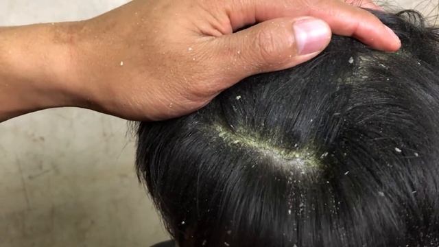 DRY SCALP !! Big Flakes Dandruff Scratching #37