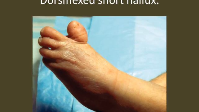 Trisomy 18 syndrome смотреть онлайн