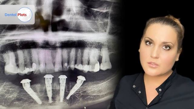 Какое главное преимущество протезирования на имплантатах по методике All-on-4?