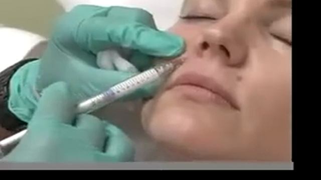 Dermal Filler Nasal Labial lines смотреть онлайн