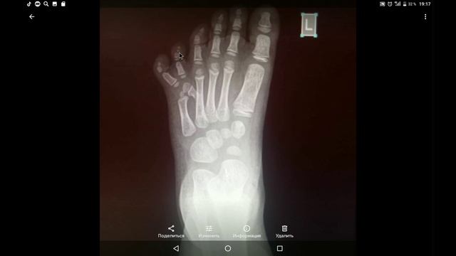 6 пальцев на ноге с рождения . Полидактилия . смотреть онлайн