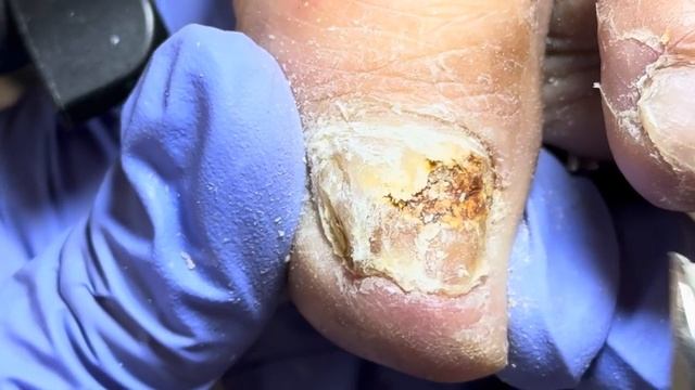 Super thick onychomycosis, remove the nails layer by layer【Doctor Liu Pedicure】 смотреть онлайн