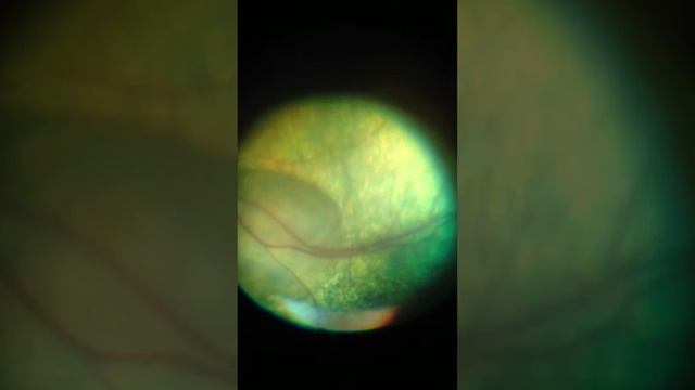 отслоение сетчатки. Кошка смотреть онлайн