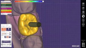 EXOCAD Моделировка индивидуального абатмента с коронкой для одномоментного фрезерования