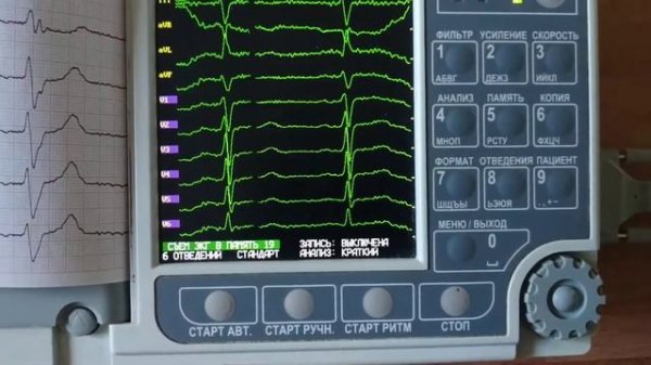 Электрокардиограф ЭК12Т-01-"Р-Д" с экраном 141мм модель G0500 с автоматическим заключением