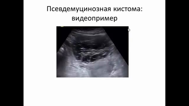 УЗИ опухолей яичников.Видеолекция смотреть онлайн