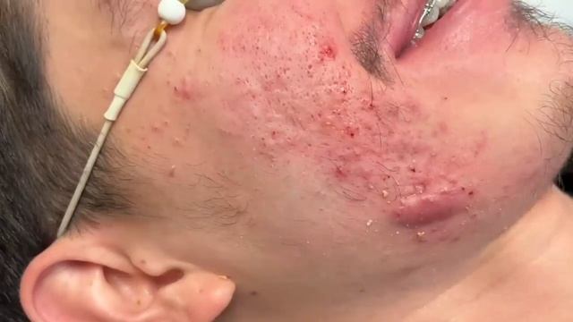 So much extracted! Severe acne before and after. Session 2. Comedones for days смотреть онлайн