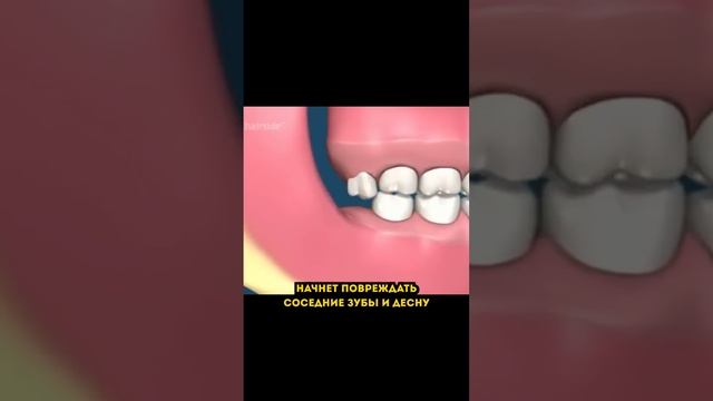 Что будет если не удалять зубы мудрости?? #стоматолог #стоматология #зубмудрости смотреть онлайн