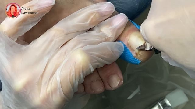 Подстригаешь сама? / Вросший ноготь / Что делать если врос ноготь /