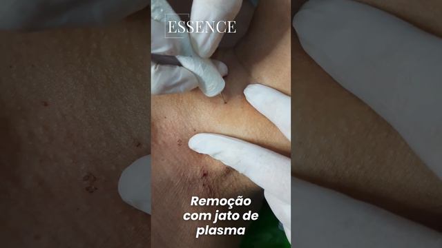 Remoção De Pinta E Verruga.