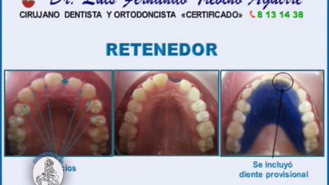INDICACIONES DE RETENEDORES FIJOS Y RETENEDORES REMOVIBLES EN ORTODONCIA смотреть онлайн