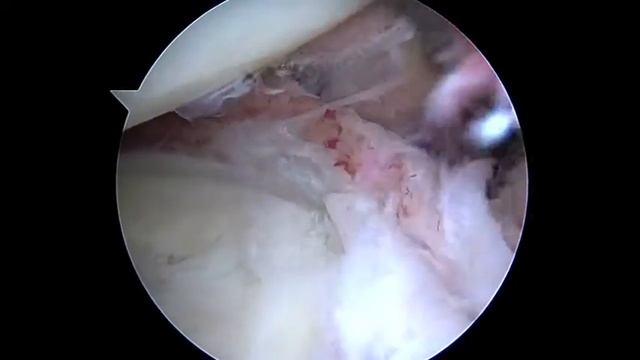 SL R arthroscopic capsular release 12 17 15 смотреть онлайн