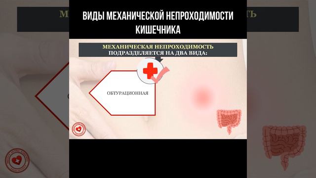 Виды механической непроходимости кишечника #непроходимость #кишечник #болитживот смотреть онлайн