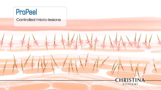 Christina Clinical ProPeel Video