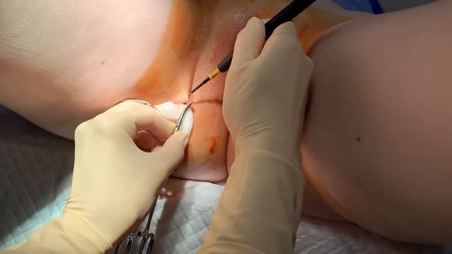 Papilloma Removal смотреть онлайн