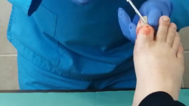 Удаление вросшегося ногтя смотреть онлайн