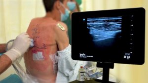 ULTRASOUND-GUIDED PARAVERTEBRAL BLOCK