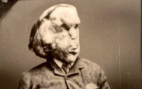 Джозеф Меррик: ЧЕЛОВЕК-СЛОН. смотреть онлайн