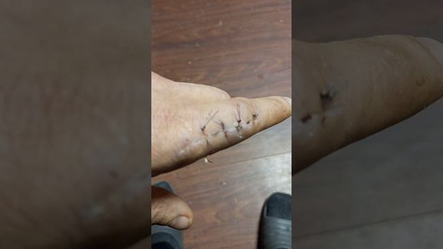 Как снять швы? смотреть онлайн