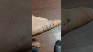 Как снять швы?