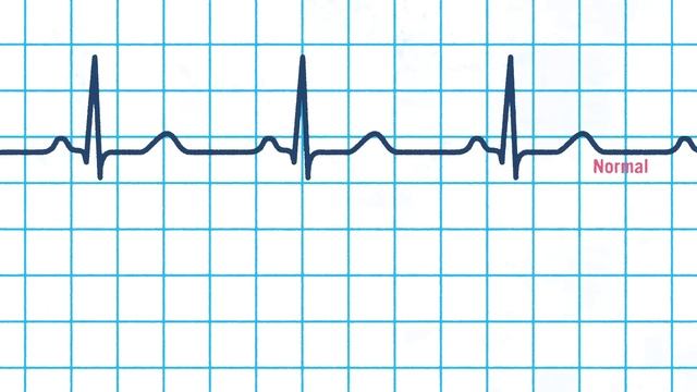 What Happens During A Heart Attack? - Krishna Sudhir