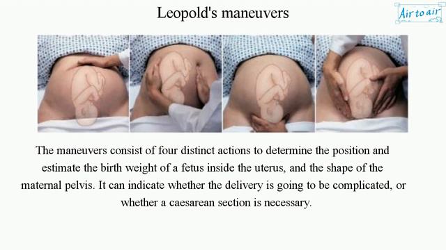 Leopold's maneuvers смотреть онлайн