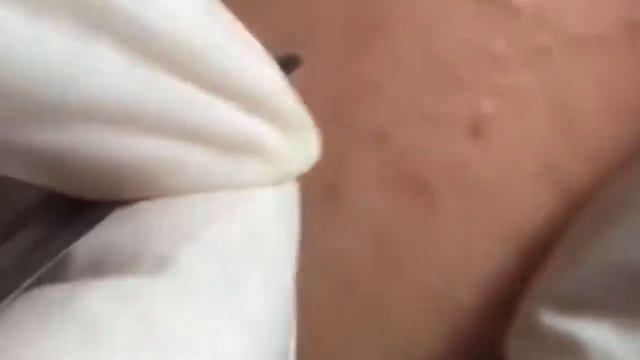 loan nguyen acne removal смотреть онлайн