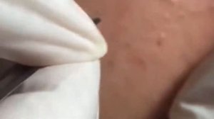 loan nguyen acne removal