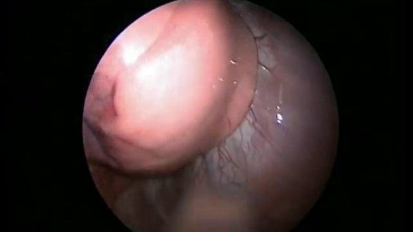 Добавочная доля правого легкого