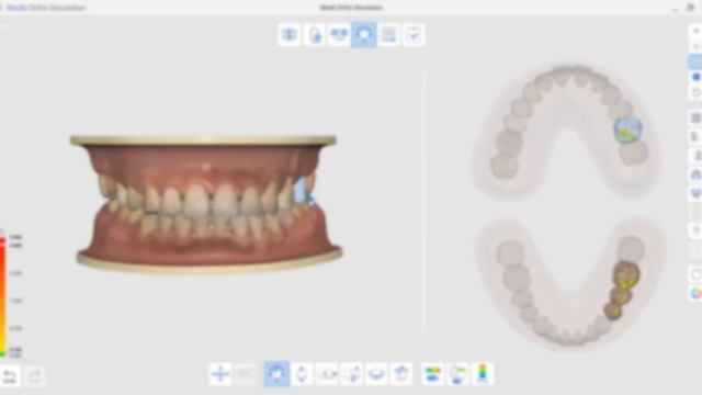 Medit Ortho Simulation