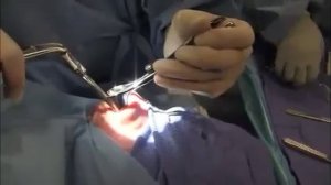 Искривление носовой перегородки операция.mp4