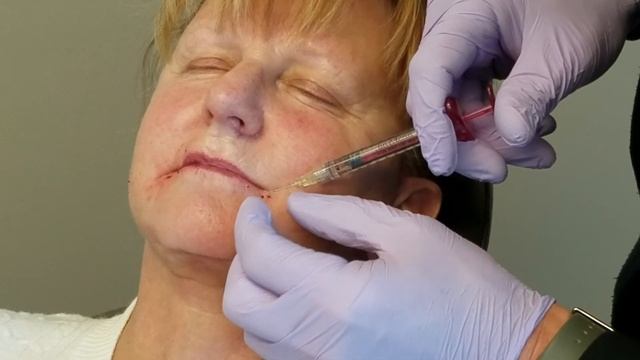 A Live VOLBELLA® Treatment For Fuller Lips