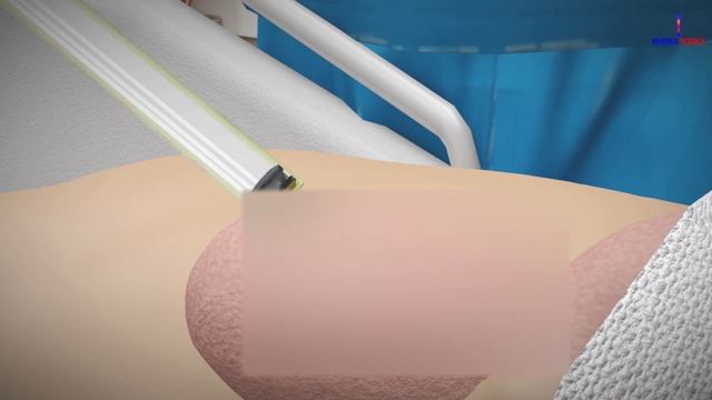 Male Sterilization: The Vasectomy Process (3D Animation) смотреть онлайн