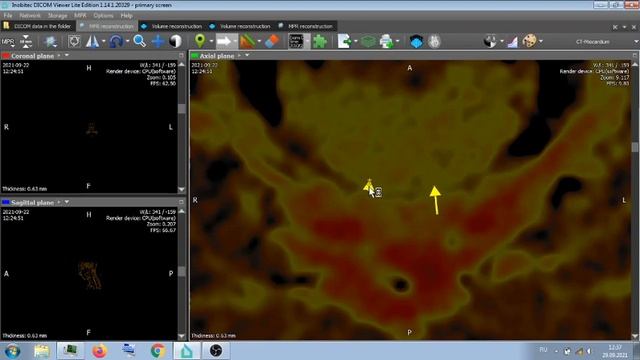 КТ АНГИОГРАФИЯ : ГОЛОВА , ШЕЯ . смотреть онлайн