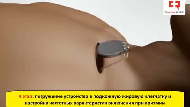Установка кардиостимулятора_ показания, этапы операции и принцип лечения аритмии сердца смотреть онлайн
