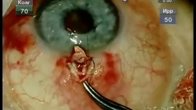 Хирургия глаукомы Стентирование шлемова канала смотреть онлайн
