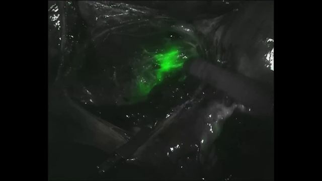 Robotic sentinel lymph node detection in endometrial cancer смотреть онлайн
