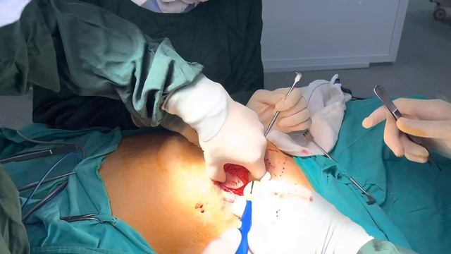 Single incision breast conservative surgery and axillary sentinel lymph node biopsy смотреть онлайн