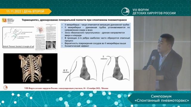 VIII Форум детских хирургов России. 11.11.2022. Спонтанный пневмоторакс