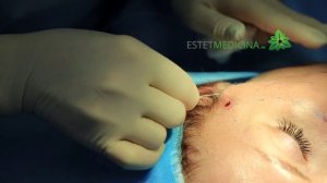 Полимолочные нити ?  Нити Resorblift  ?  УСТАНОВКА нитей для лица. Нитевой лифтинг