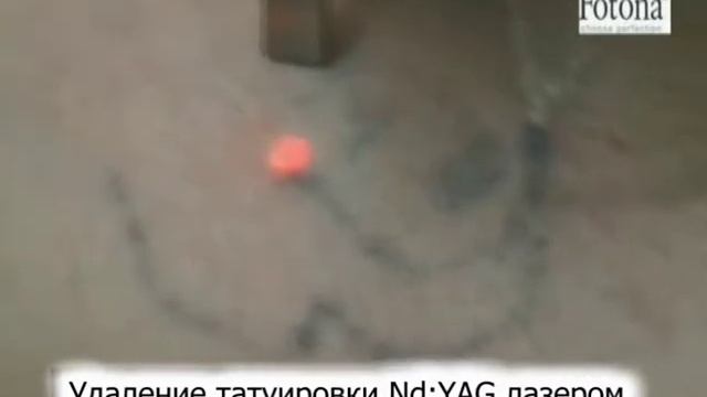 Удаление татуировок лазером Fotona Кременчуг.Салон Лилу смотреть онлайн
