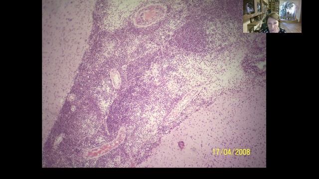 Лекция для студентов 3 курса. Инфекционные болезни. Инфекции детского возраста смотреть онлайн