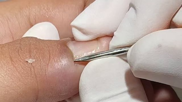 OVERGROWN INFECTED INGROWN TOENAIL REMOVAL (PODOLOGIA EM UNHA ENCRAVADA)