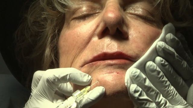 Laser And Mohs: Belotero To Erase Fine Lines
